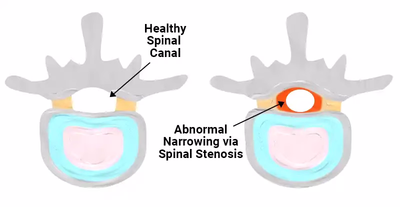 an illustration showing how the intervertebral can shrink over time